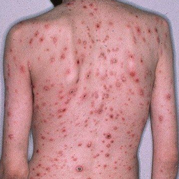 Syphilis