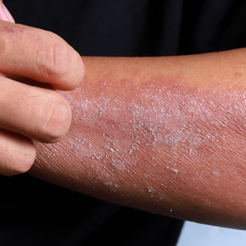 Eczema and Psoriasis